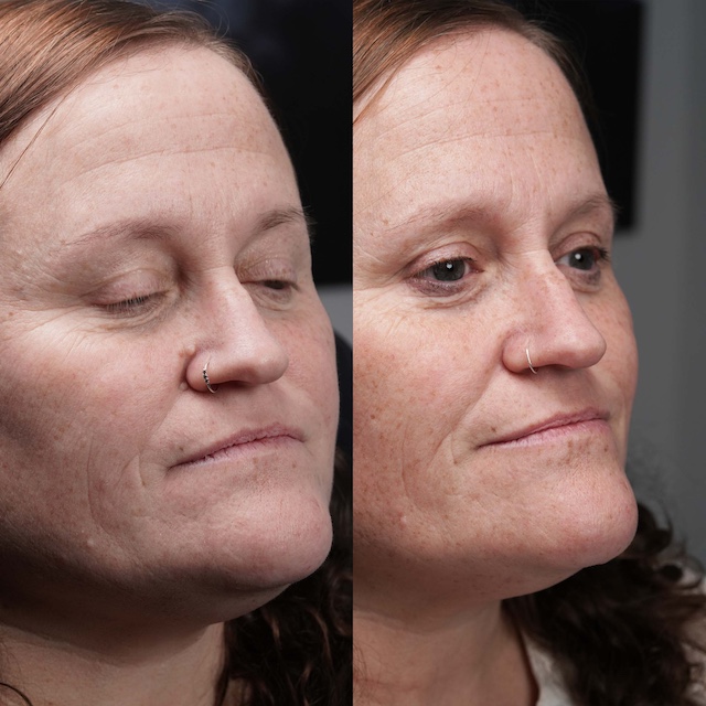 Fibroma before and after pic