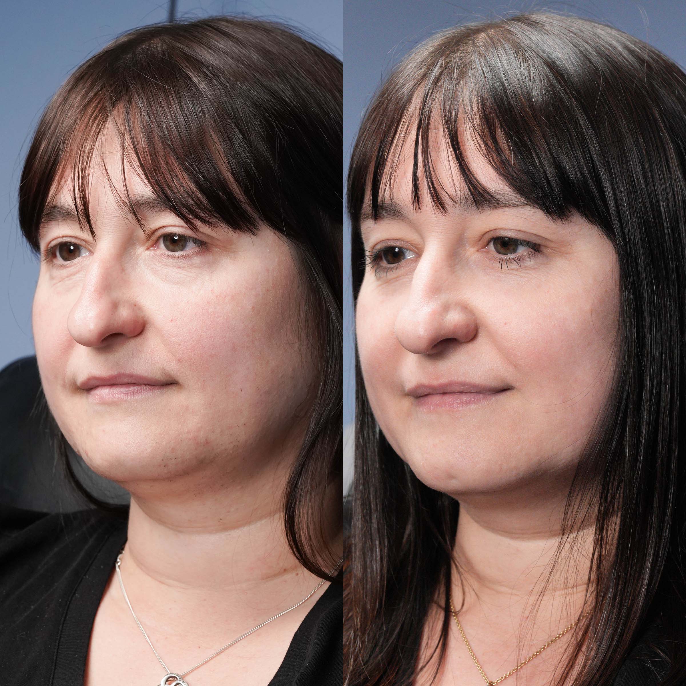 hair removal transformation