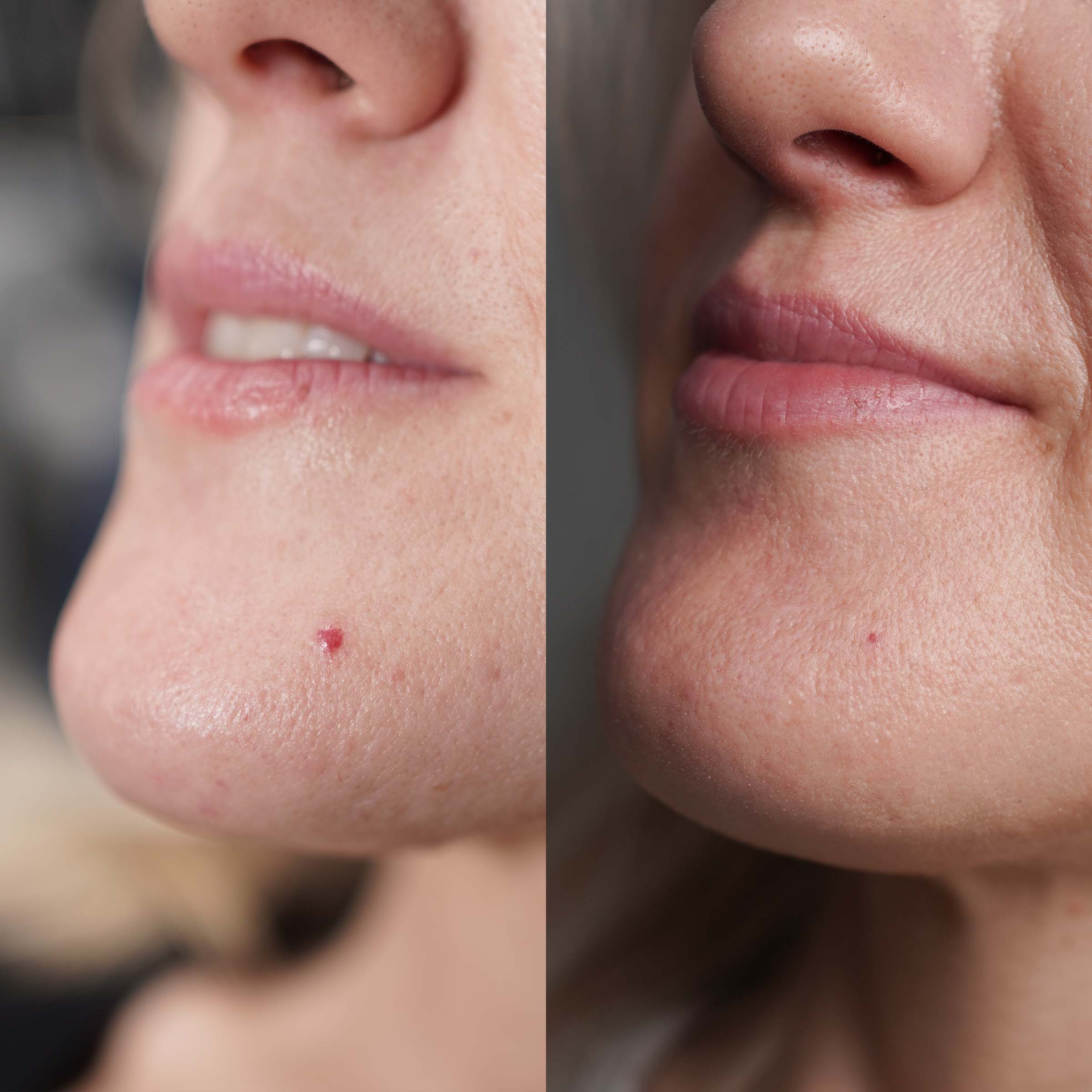 Highland Laser Clinic Blog Index Page