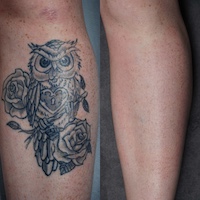 “Laser tattoo removal on shin – before and after”