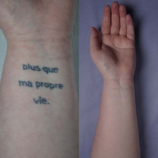 Tattoo removal before and after