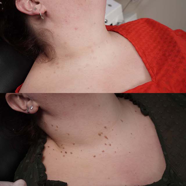 Skin tag removal before and after