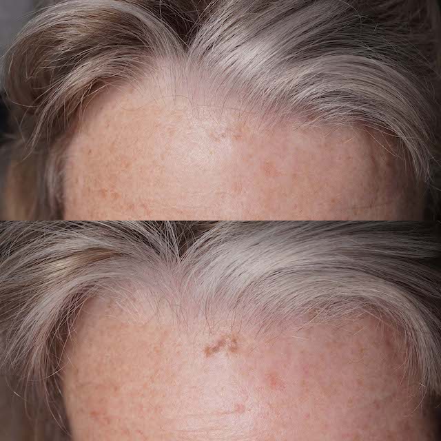 Solar Lentigo removal before and after