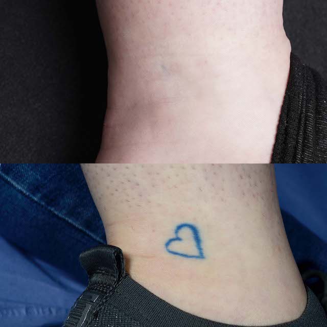 Tattoo removal before and after