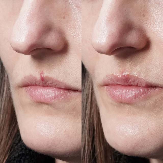 Venous lake treatment before and after